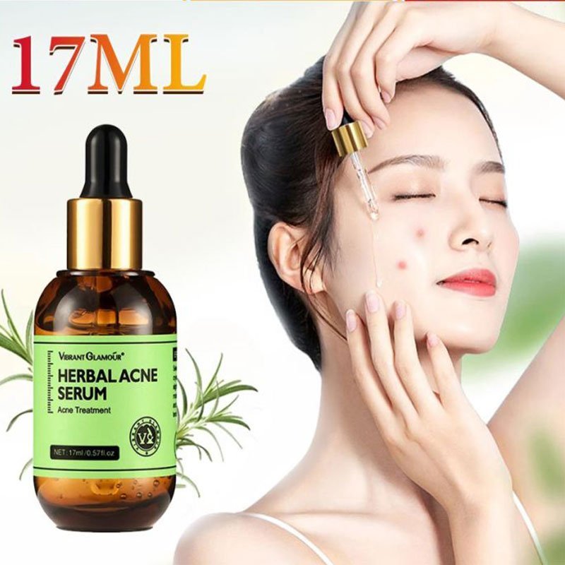 VIBRANT GLAMOUR Herbal Acne Serum Acne Treatment 17ml